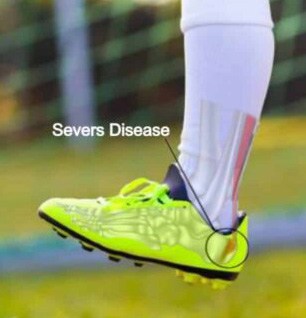 What is Sever's Disease in Children with Heel Pain